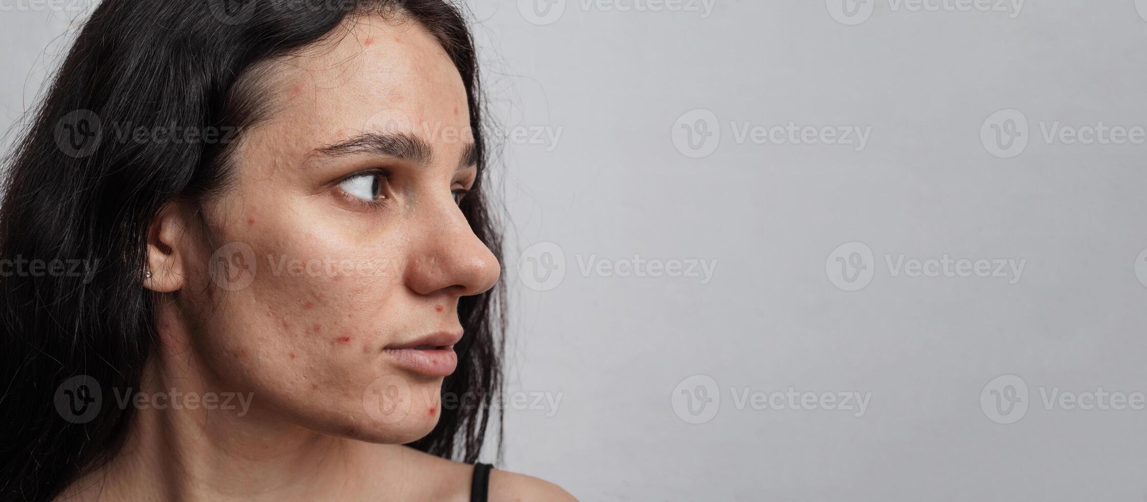 Close-up of a young woman with acne on her face and skin problems. A panoramic shot on the banner. a place for your text photo