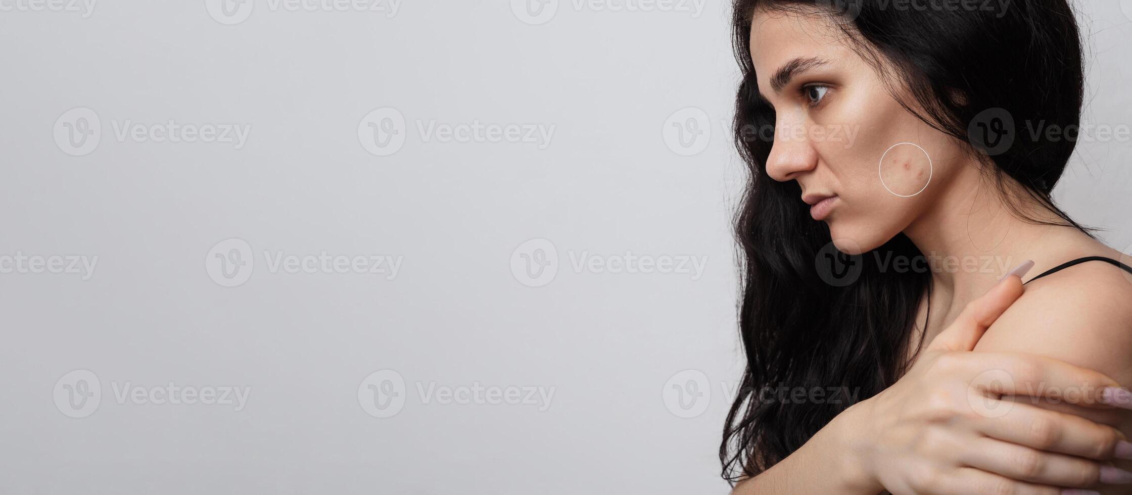 Close-up of a young girl with skin problems. Pimples, acne, pores, scars. Natural skin with and without filters. A place for your text. photo