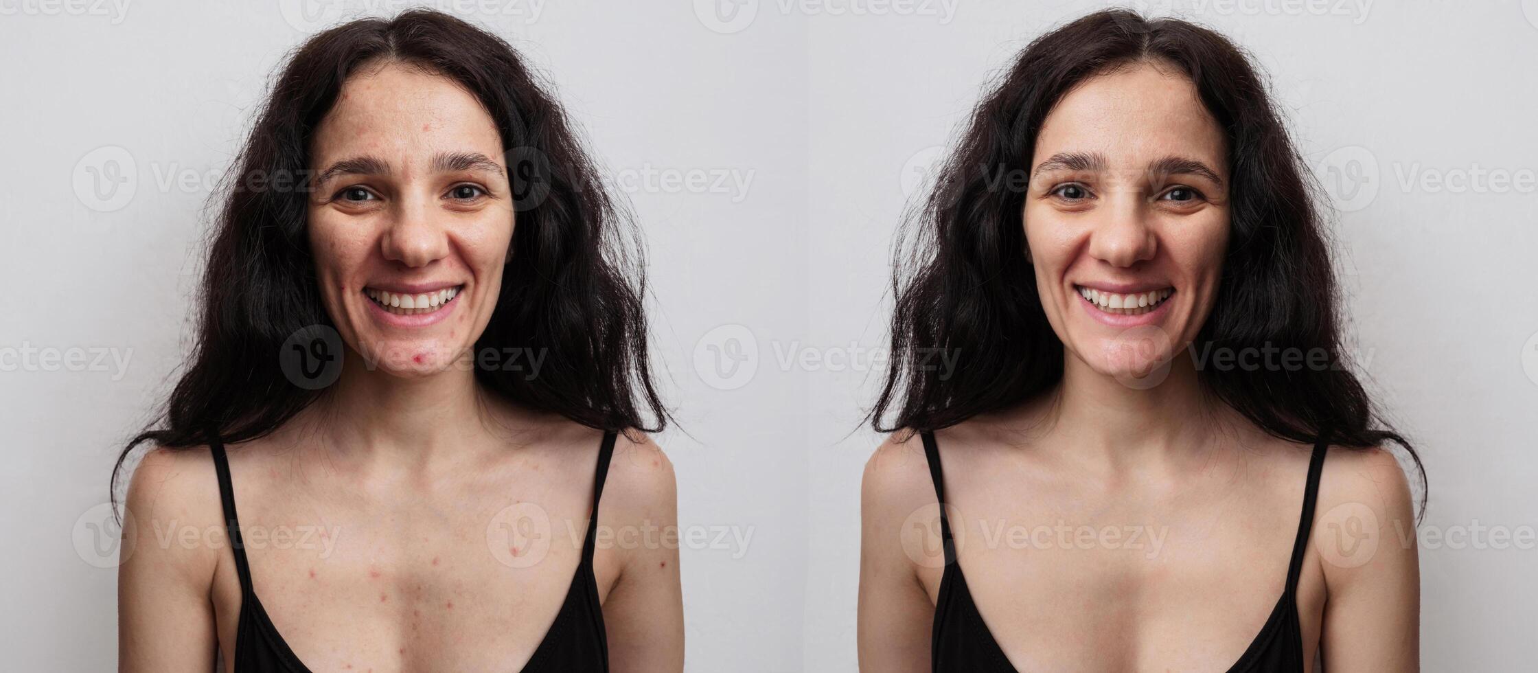 A young woman before and after acne treatment on a beige background photo