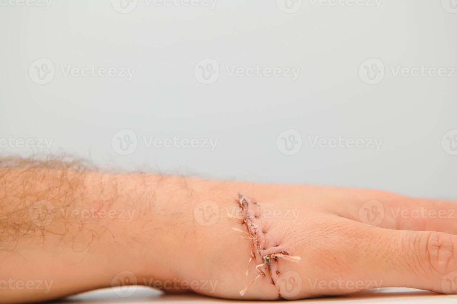 Close-up of a hand wound with stitches photo