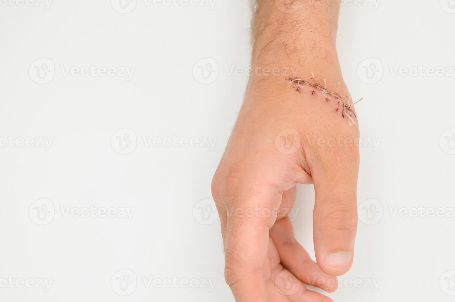 Suture wound on hand,Pain of accident concept photo