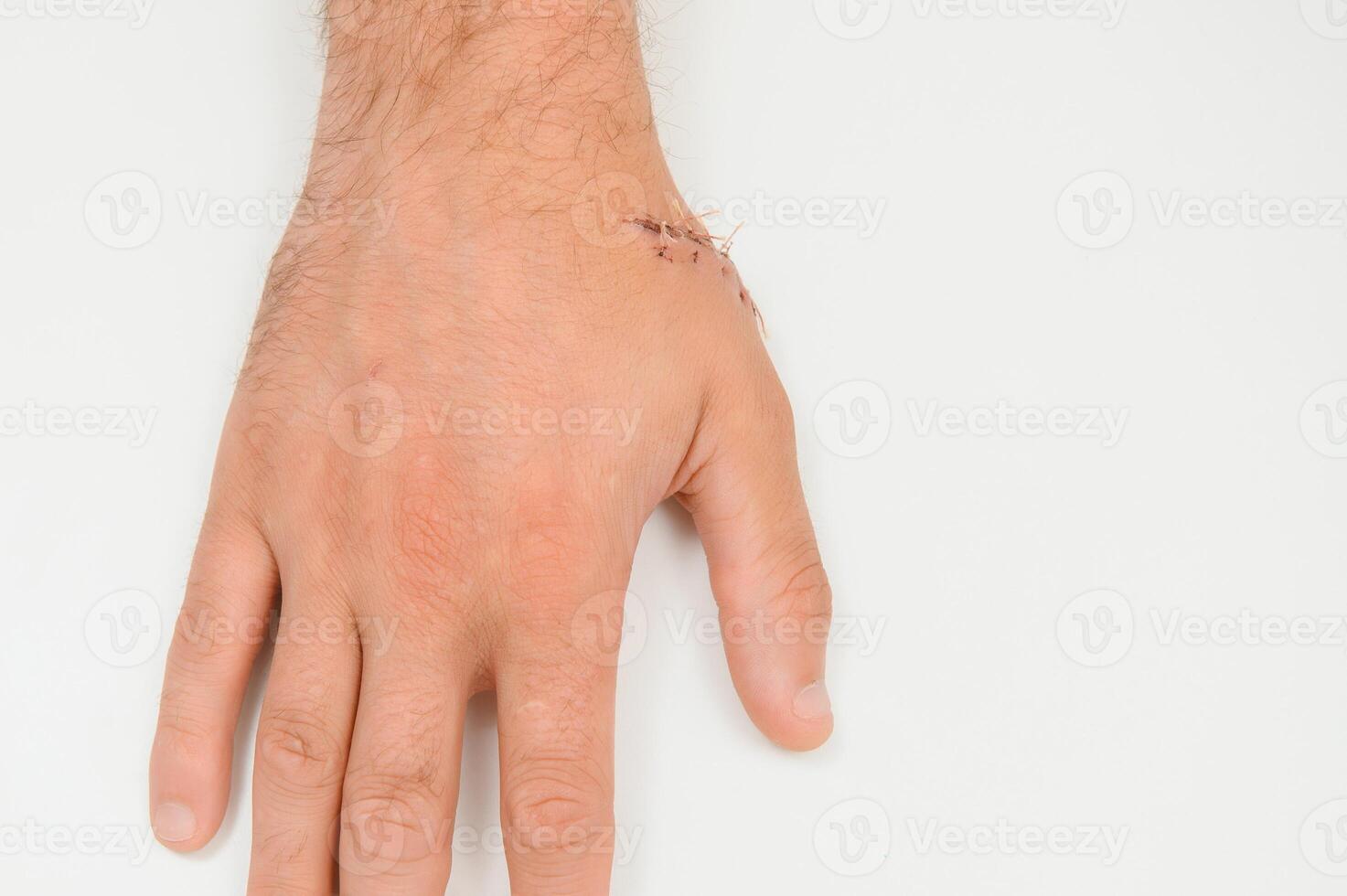 Close-up of a hand wound with stitches photo