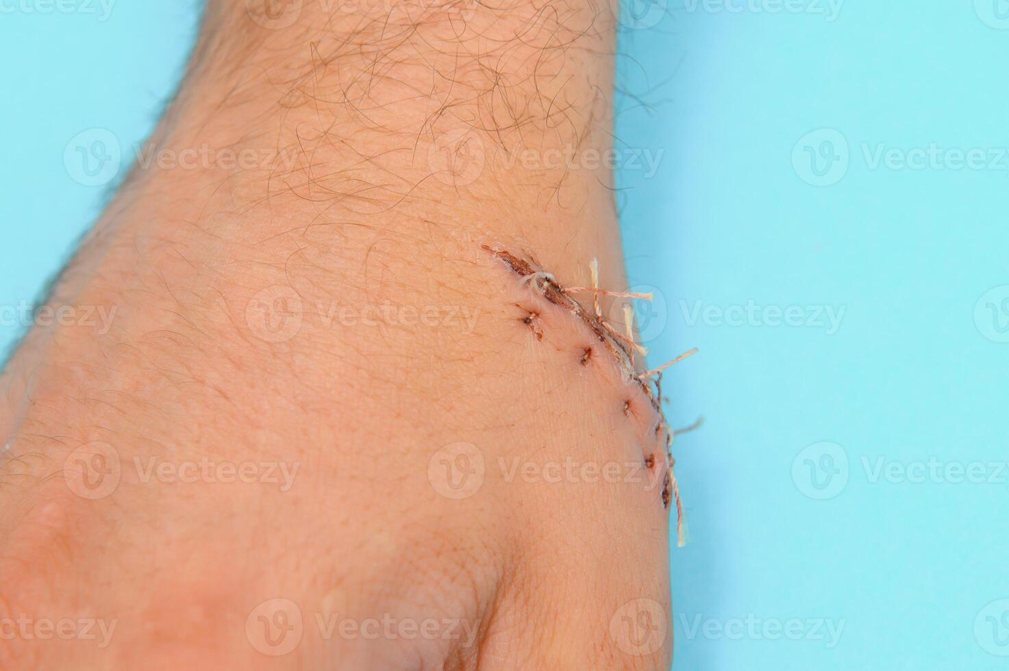 Suture wound on hand,Pain of accident concept photo