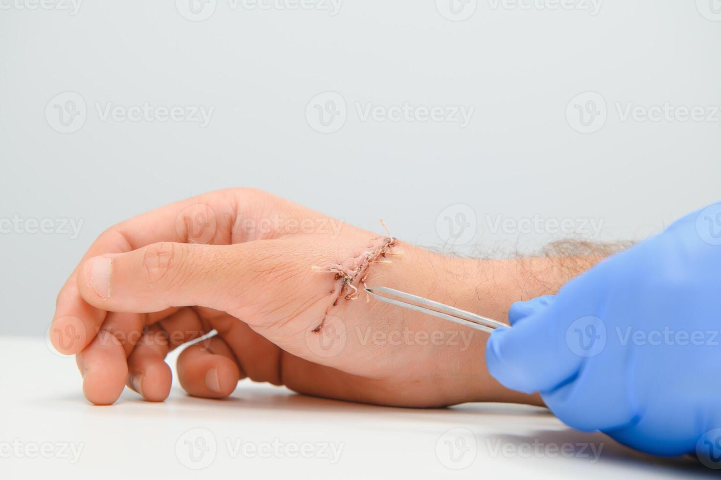 wound hand, suturing the wound. The type of cut after surgery. photo