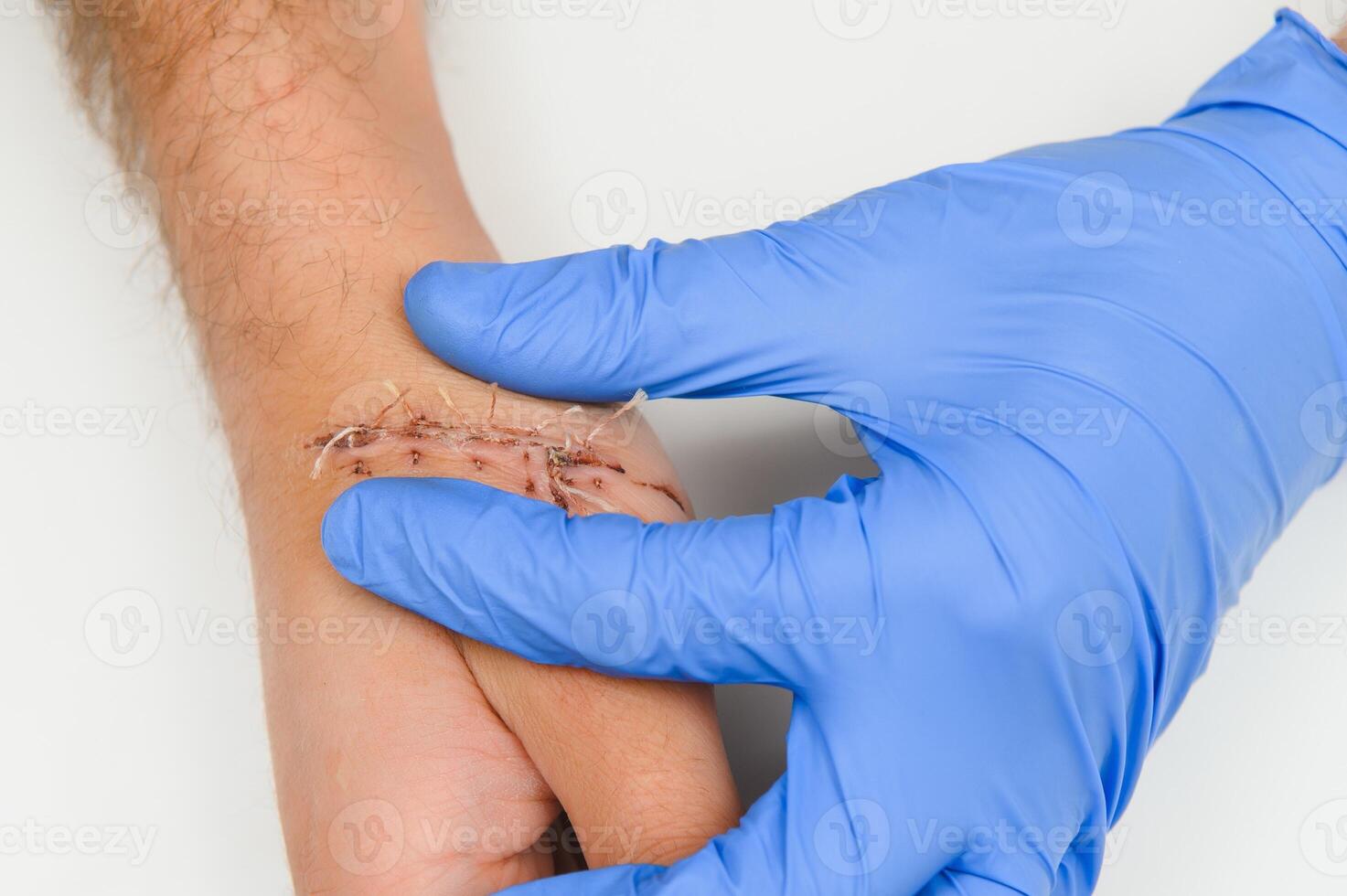 Suture wound on hand,Pain of accident concept photo