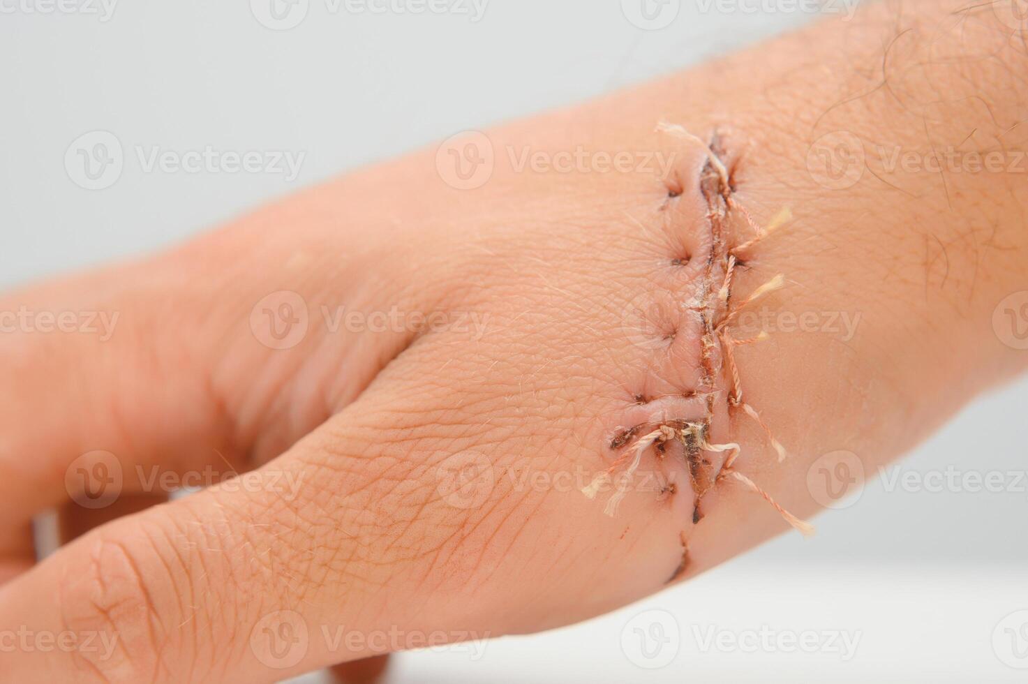 wound hand, suturing the wound. The type of cut after surgery. photo