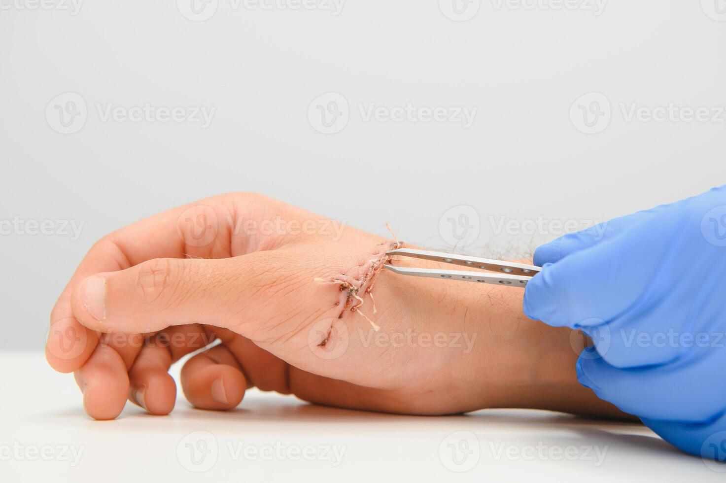Suture wound on hand,Pain of accident concept photo