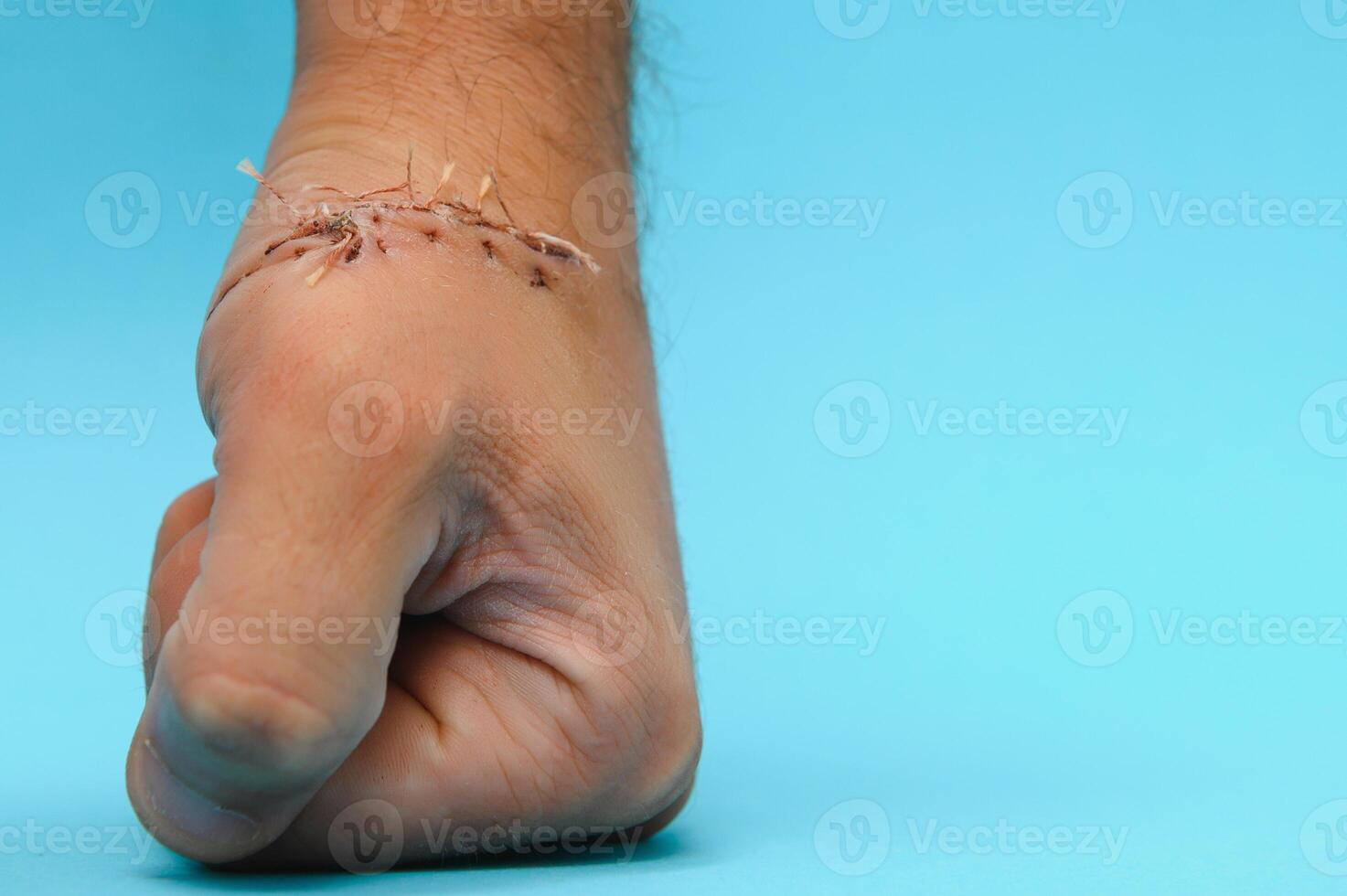 Suture wound on hand from dermatology procedure photo