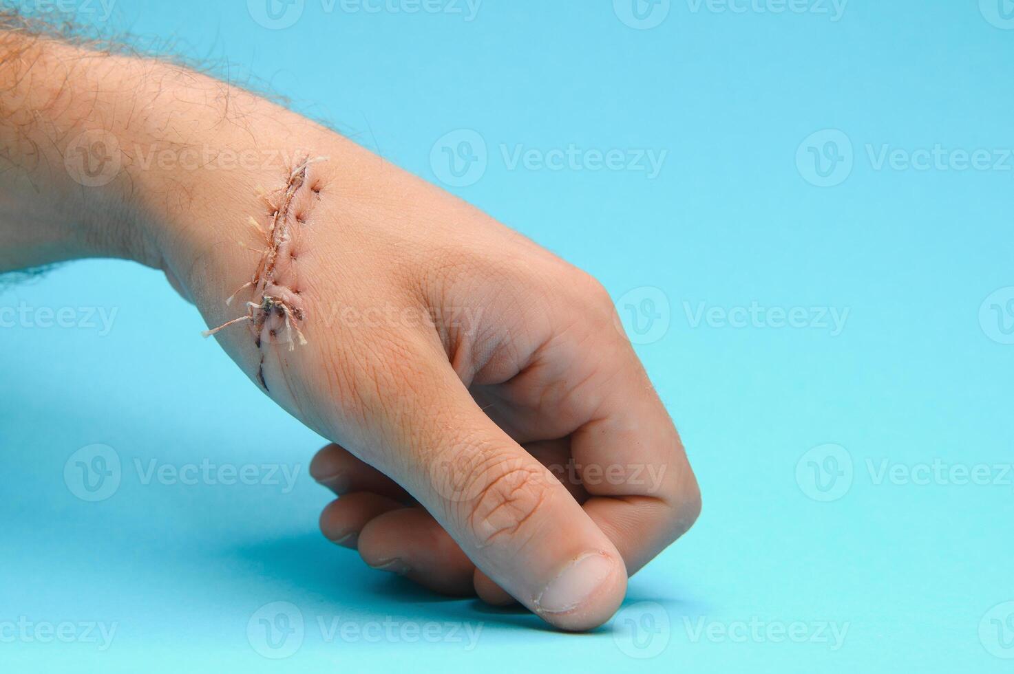 Close-up of a hand wound with stitches photo