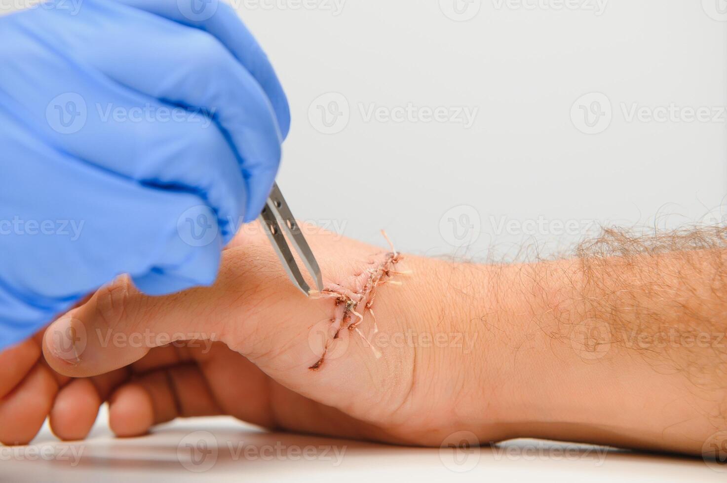 Doctor examining nerve conduction on palm of hand after carpal tunnel syndrome photo
