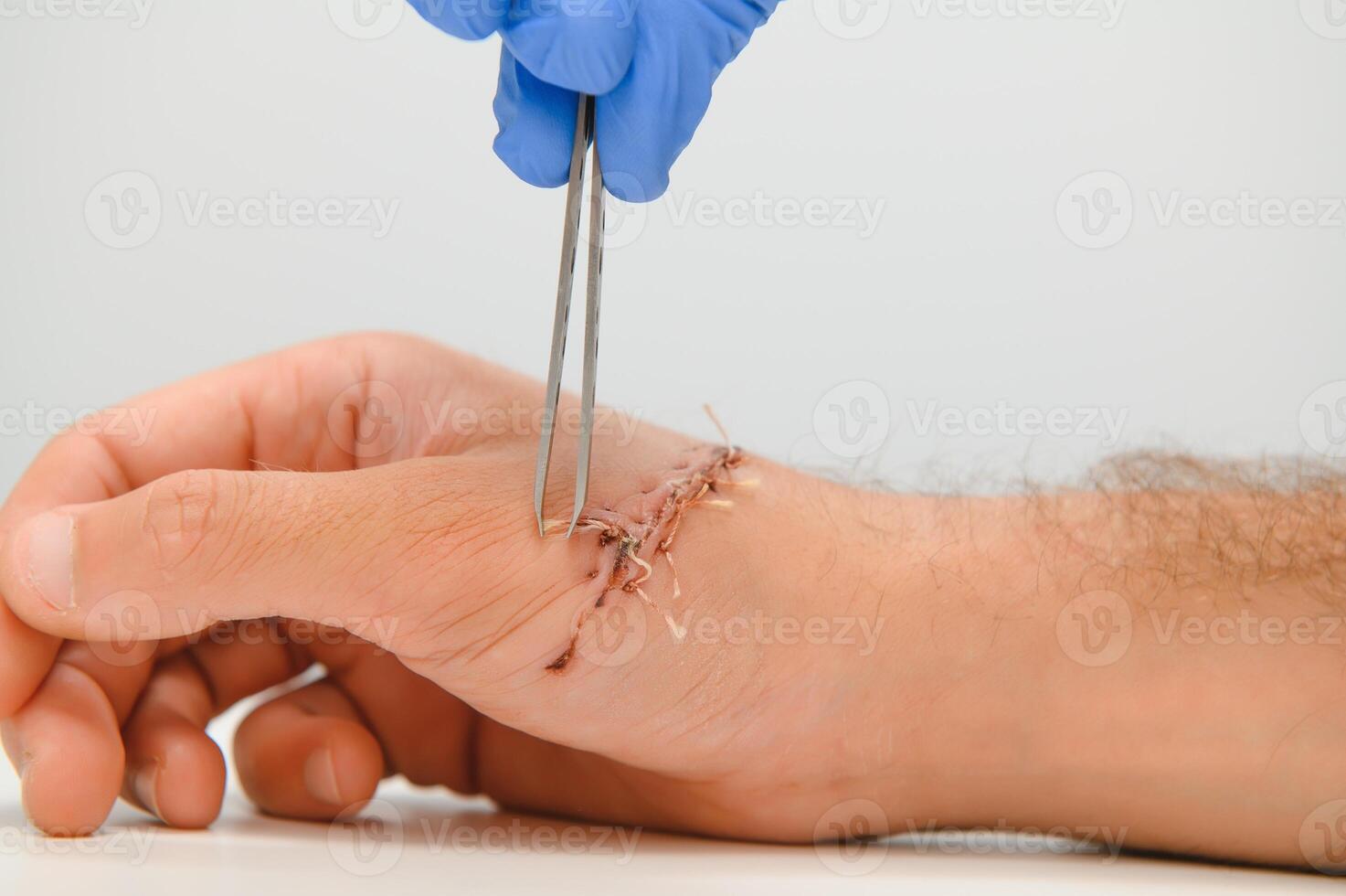 Suture wound on hand,Pain of accident concept photo