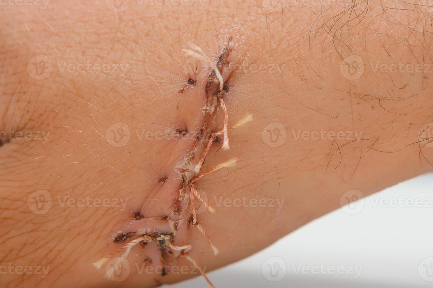 Close-up of a hand wound with stitches photo