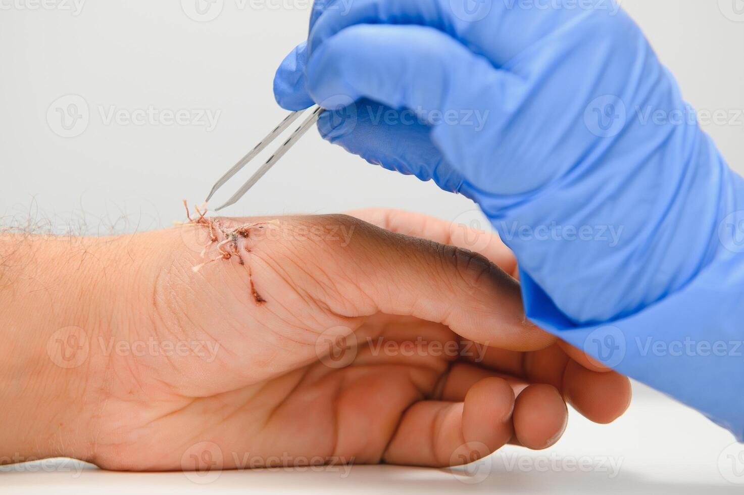 Doctor examining nerve conduction on palm of hand after carpal tunnel syndrome photo