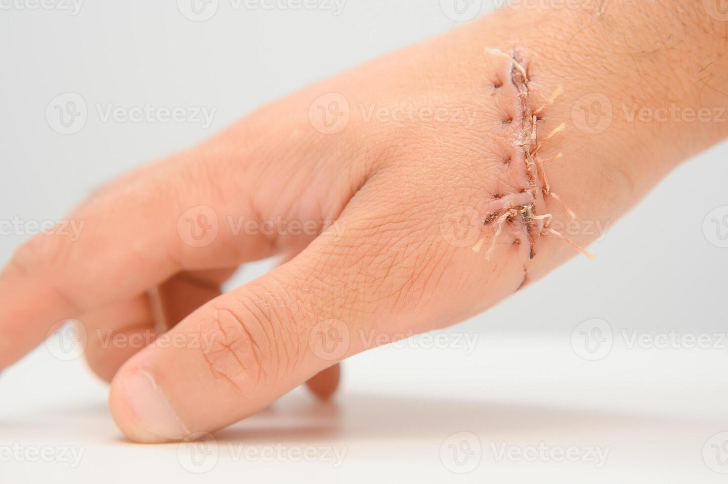 Close-up of a hand wound with stitches photo