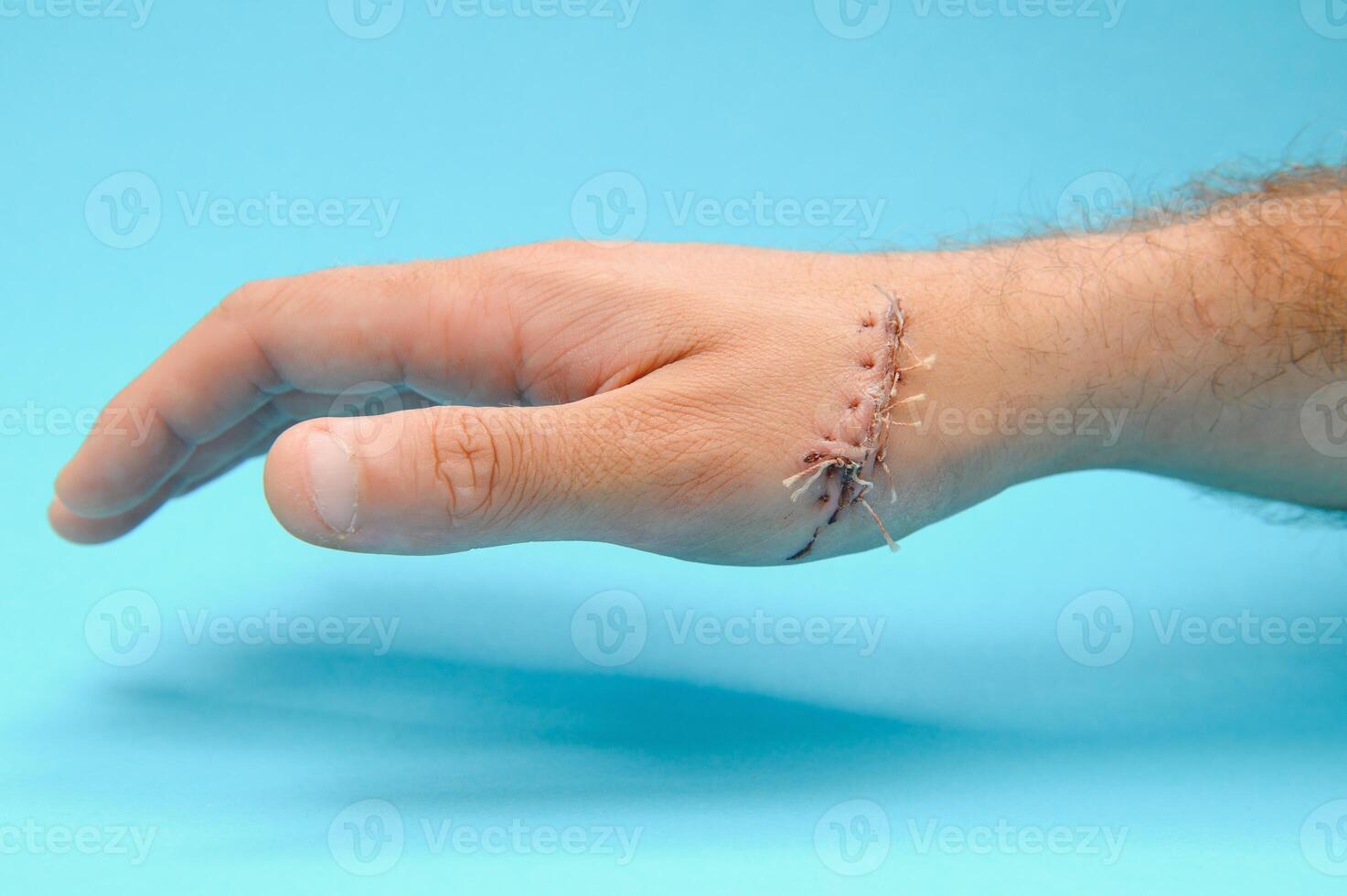 wound hand, suturing the wound. The type of cut after surgery. photo