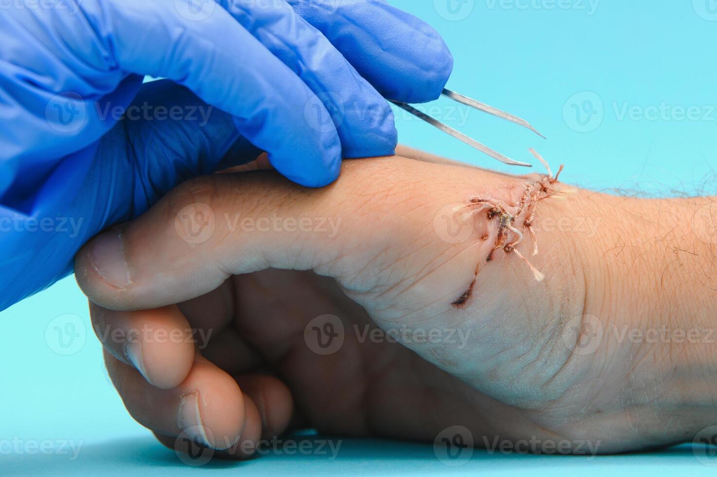 Suture wound on hand,Pain of accident concept photo