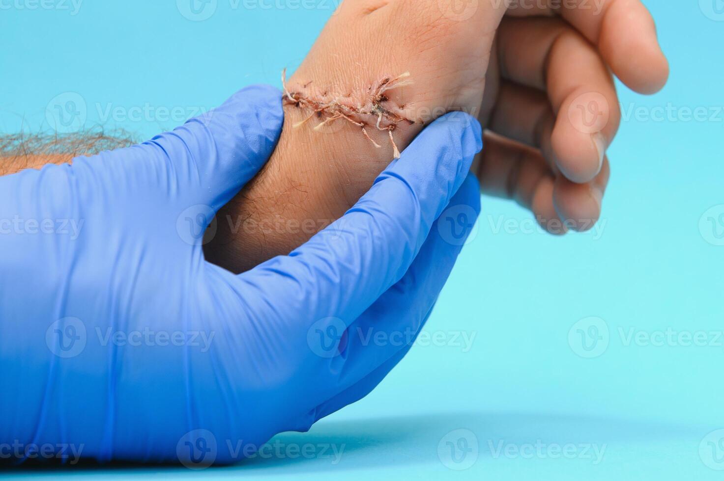 Suture wound on hand from dermatology procedure photo