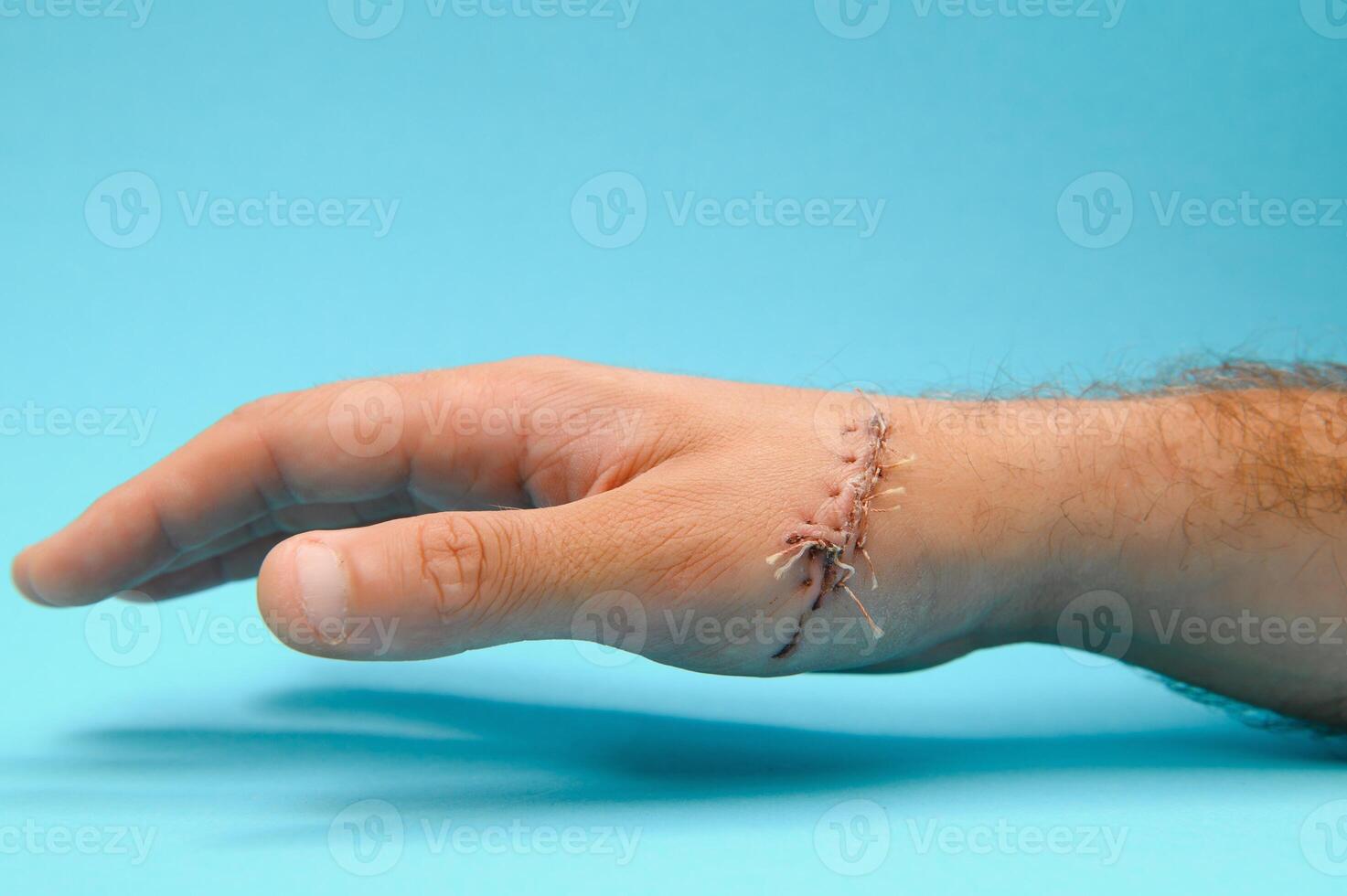 Suture wound on hand,Pain of accident concept photo