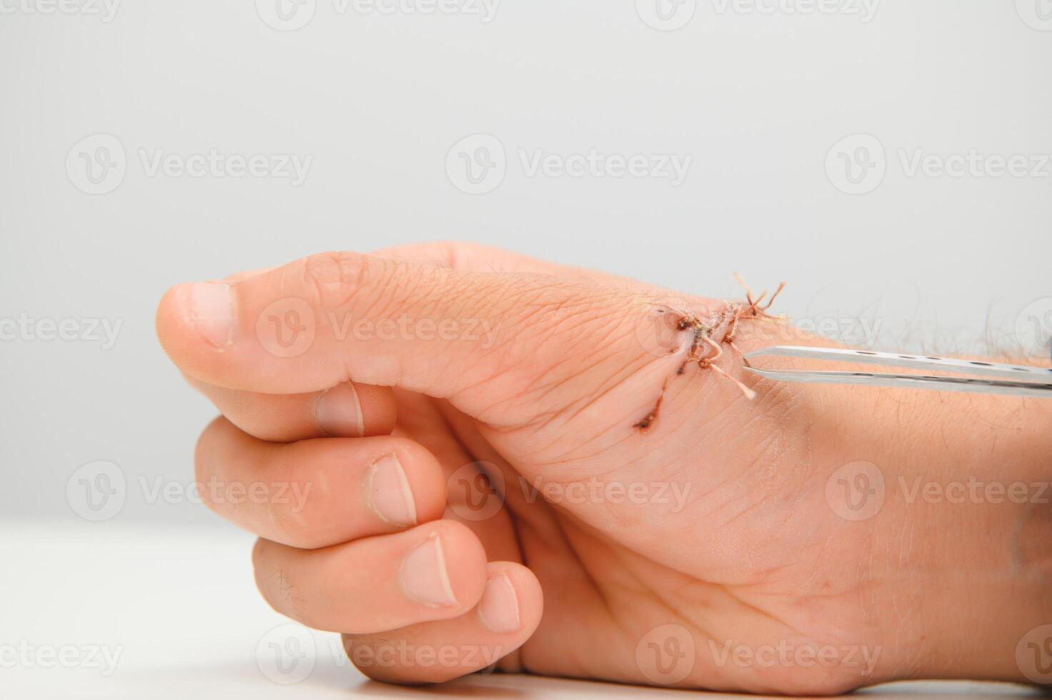 Close-up of a hand wound with stitches photo