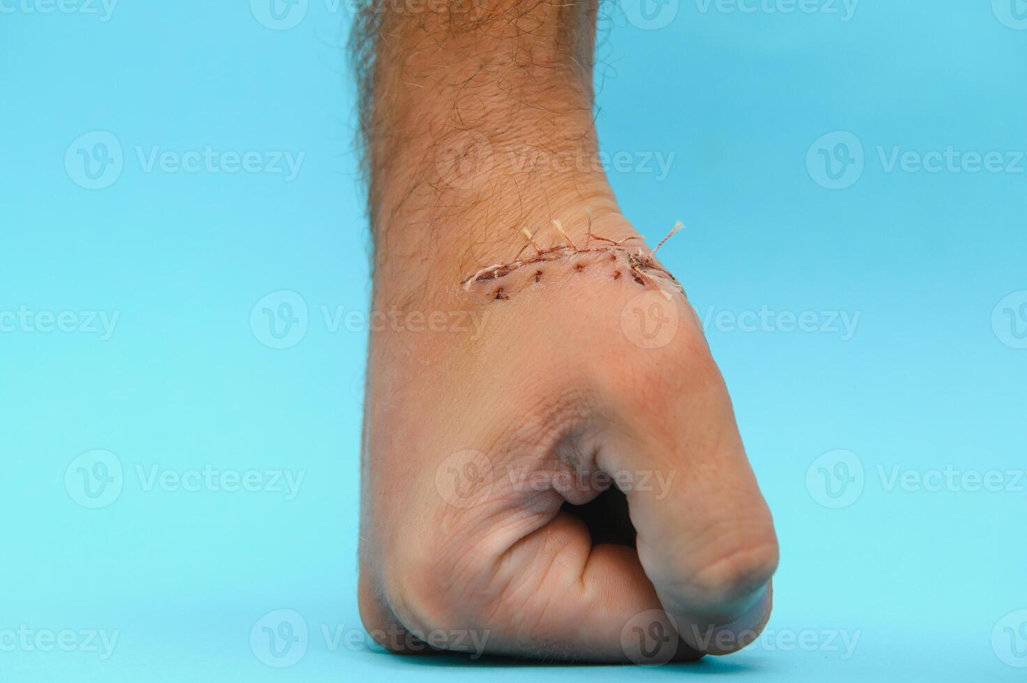 Suture wound on hand,Pain of accident concept photo