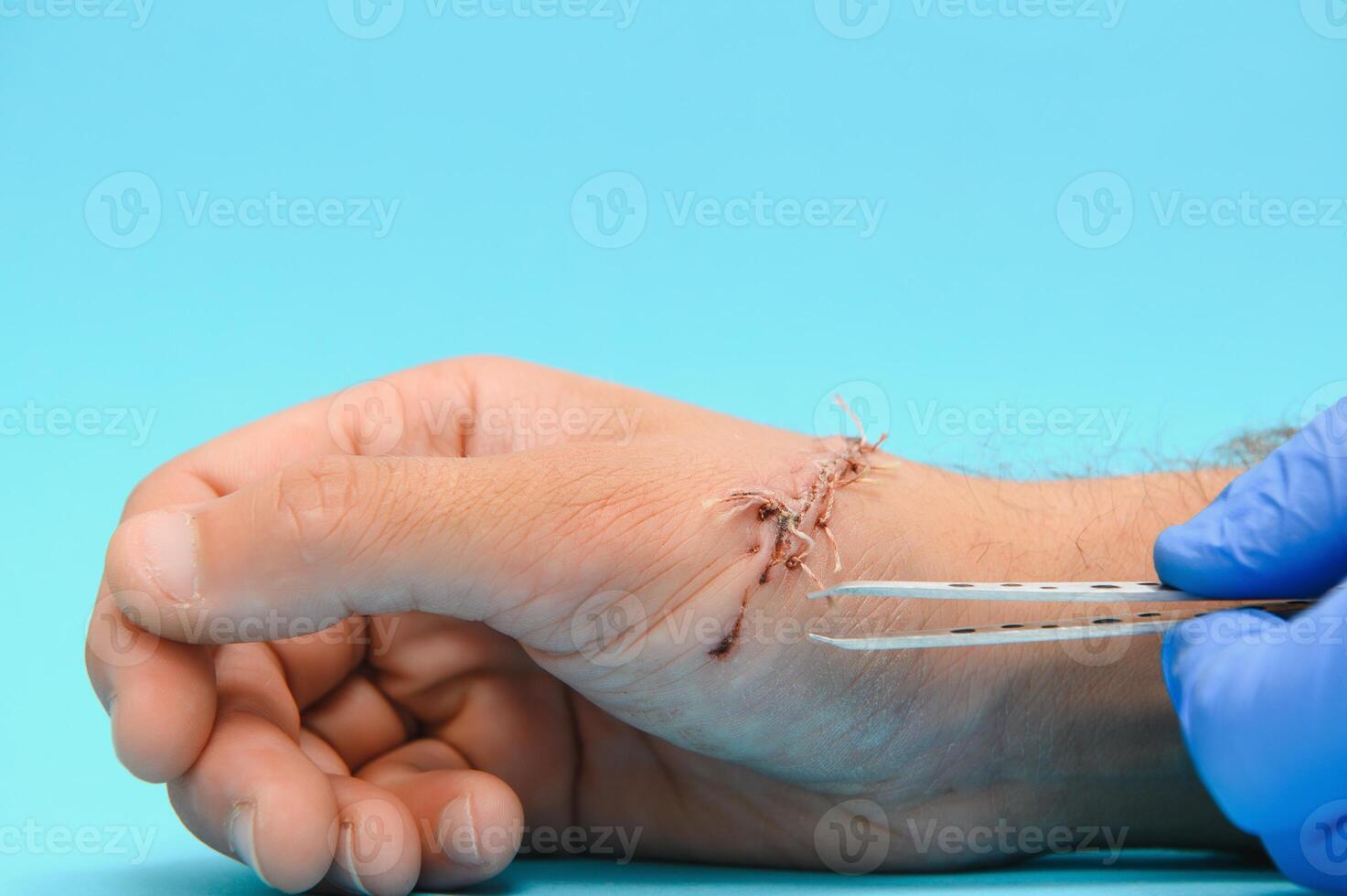 Suture wound on hand from dermatology procedure photo