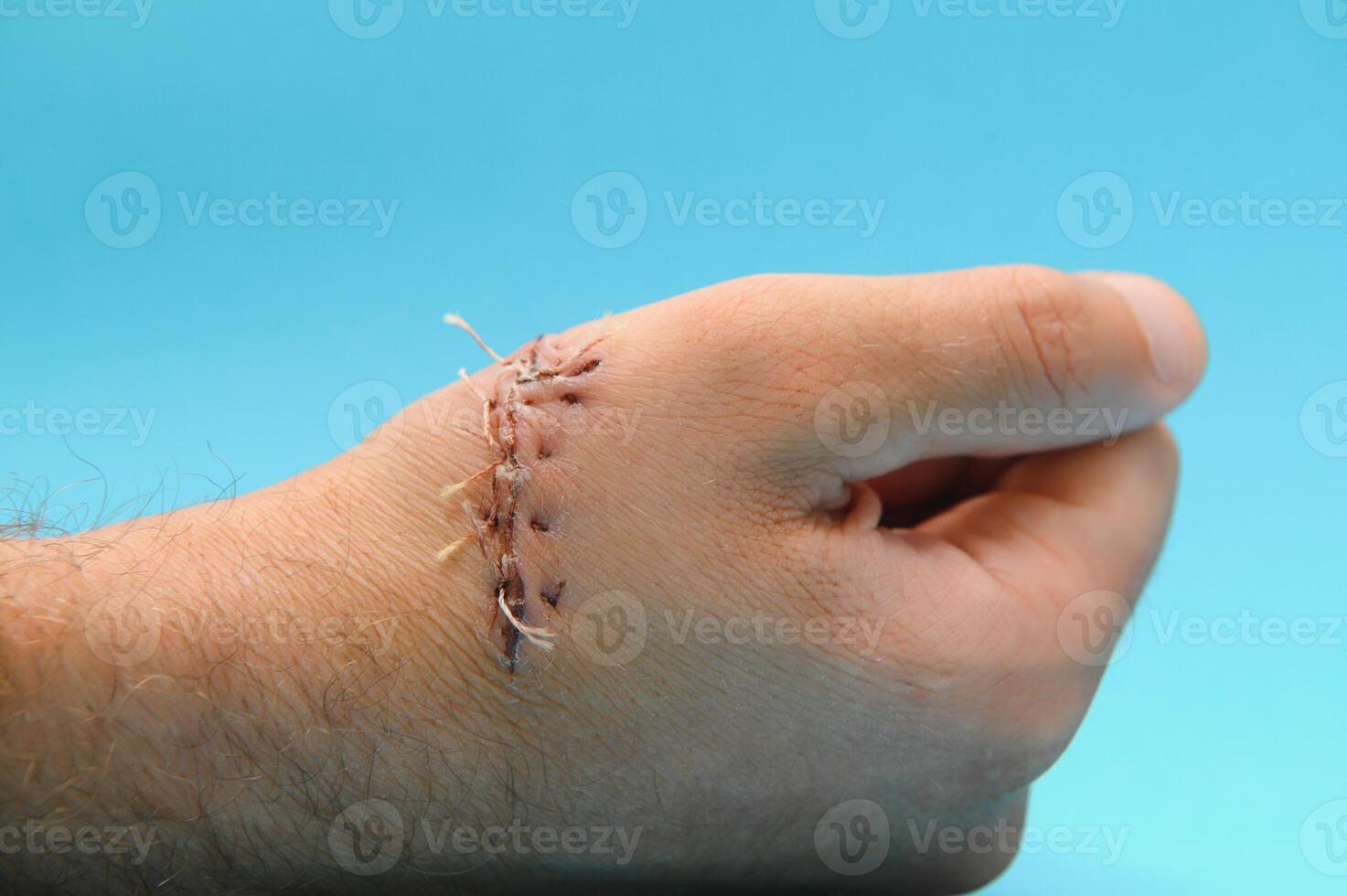 Close-up of a hand wound with stitches photo