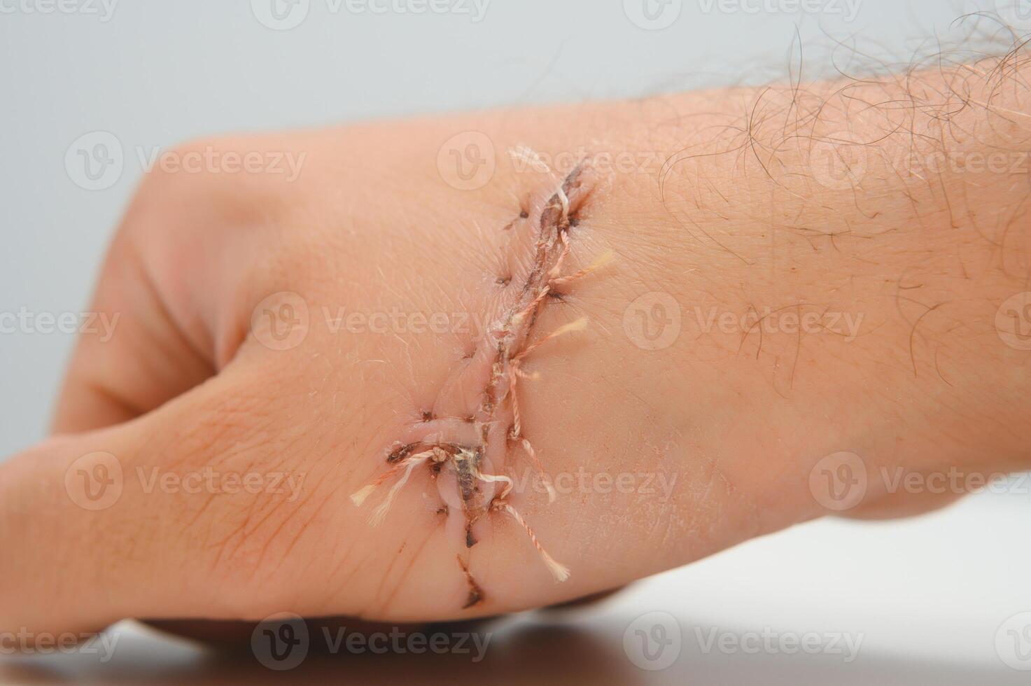 wound hand, suturing the wound. The type of cut after surgery. photo