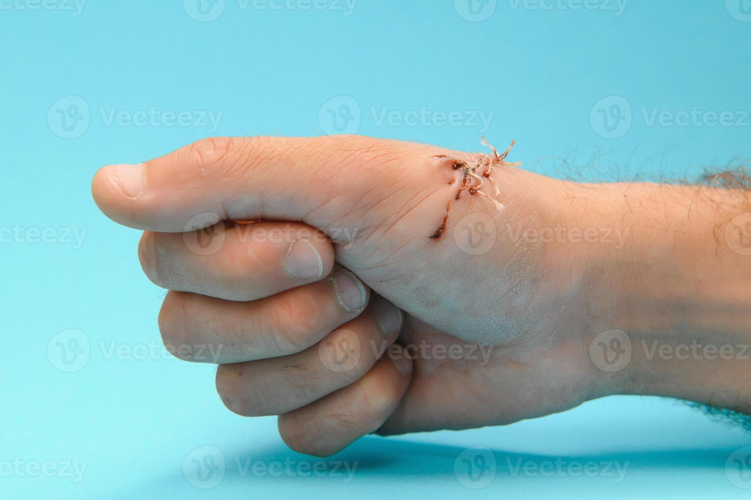 Suture wound on hand,Pain of accident concept photo