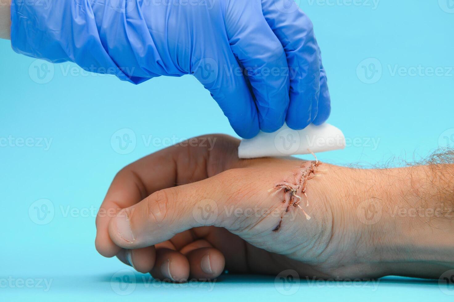nurse cleaning wound with cotton ball and dressing set, wound care process photo