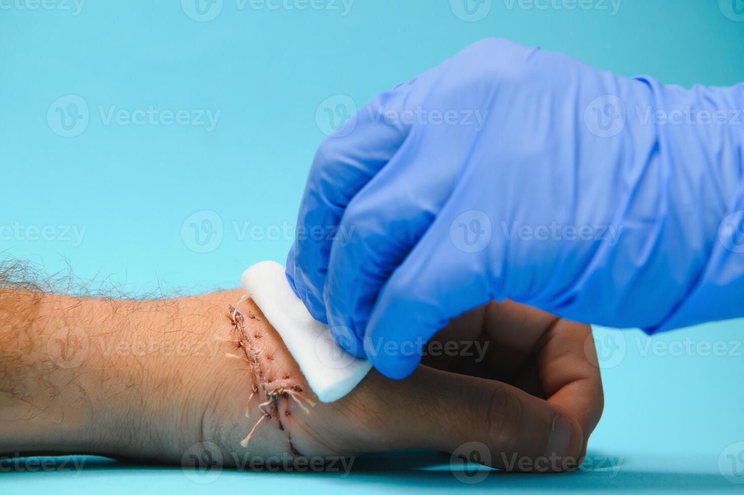 nurse cleaning wound with cotton ball and dressing set, wound care process photo
