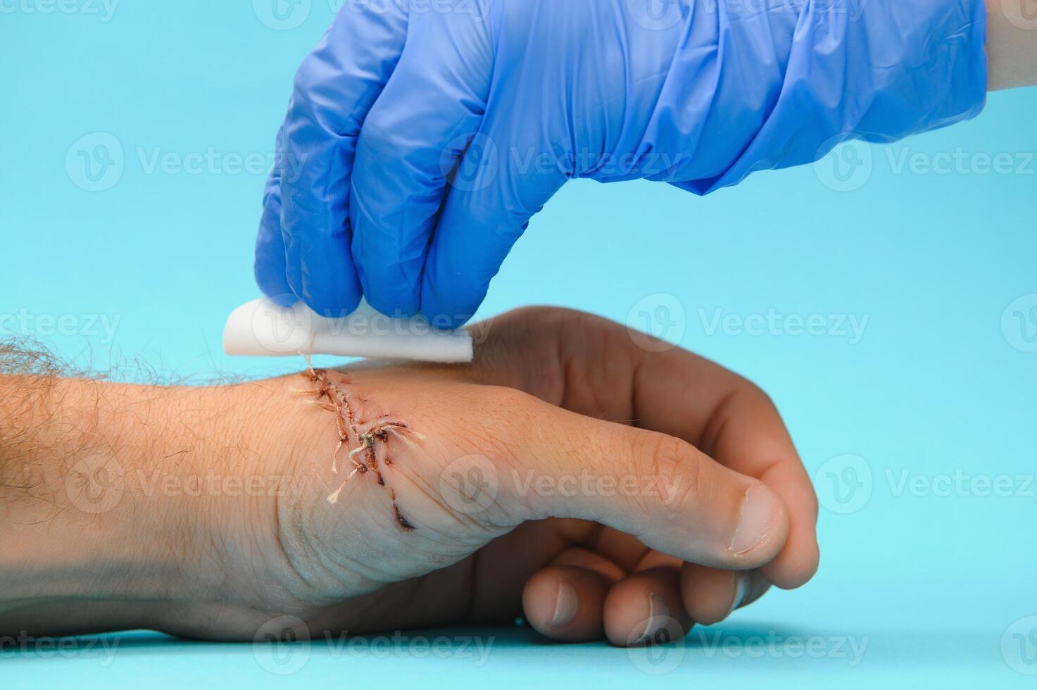 nurse cleaning wound with cotton ball and dressing set, wound care process photo