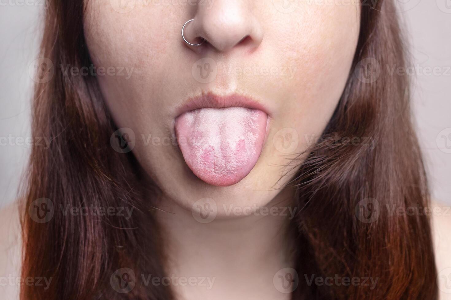 Woman shows a white tongue. A common symptom of a candida albicans yeast infection or stomatitis. health problems, mouth problems photo