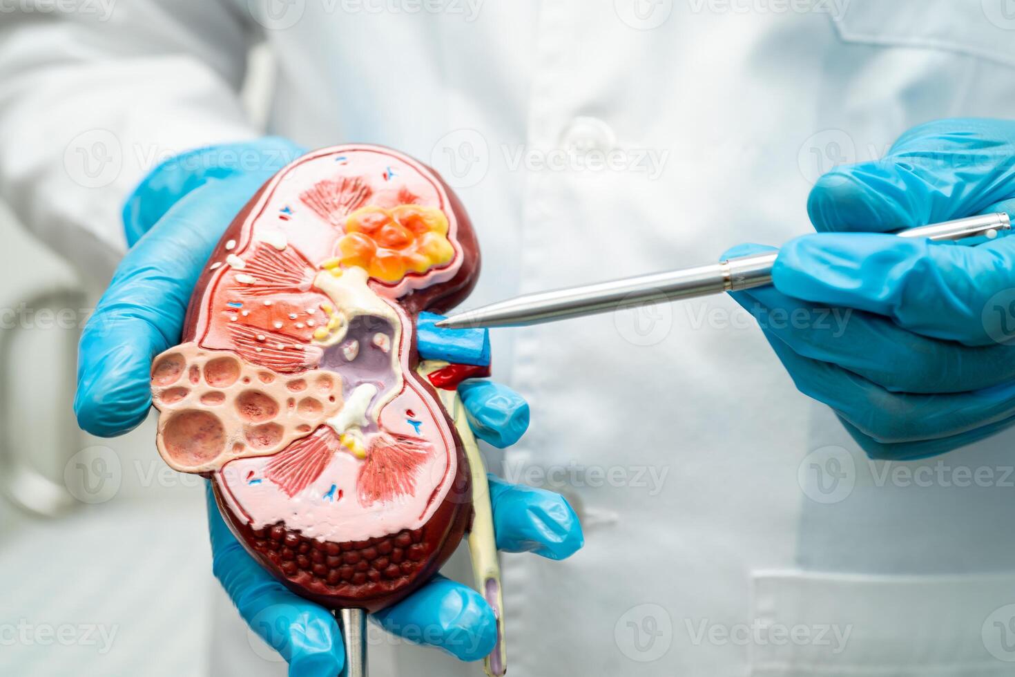Kidney disease, Chronic kidney disease ckd, Doctor with human model to study and treat in hospital. photo