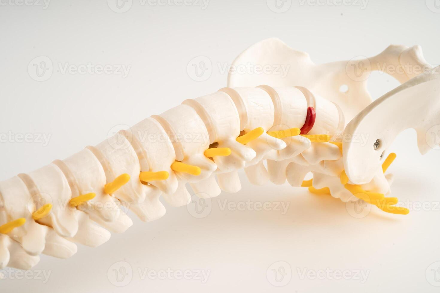 Lumbar spine displaced herniated disc fragment, spinal nerve and bone. Model for treatment medical in the orthopedic department. photo