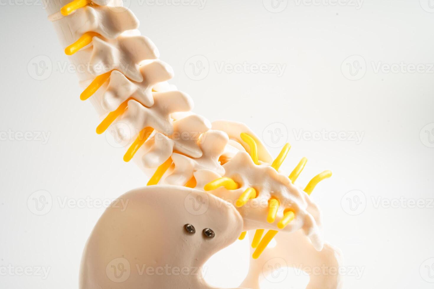Lumbar spine displaced herniated disc fragment, spinal nerve and bone. Model for treatment medical in the orthopedic department. photo