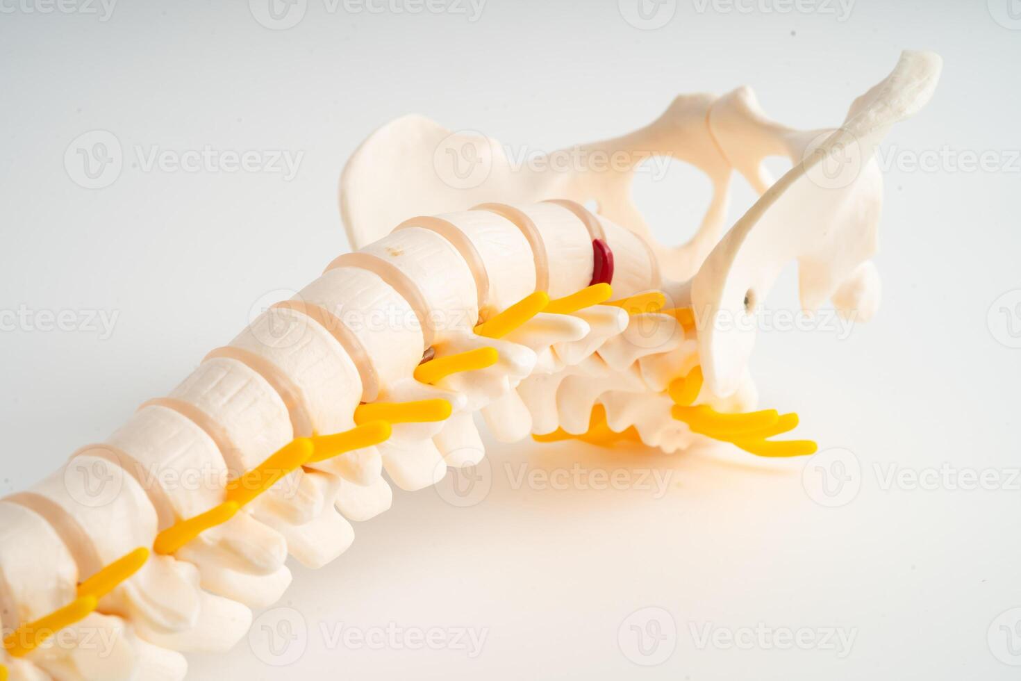 Lumbar spine displaced herniated disc fragment, spinal nerve and bone. Model for treatment medical in the orthopedic department. photo