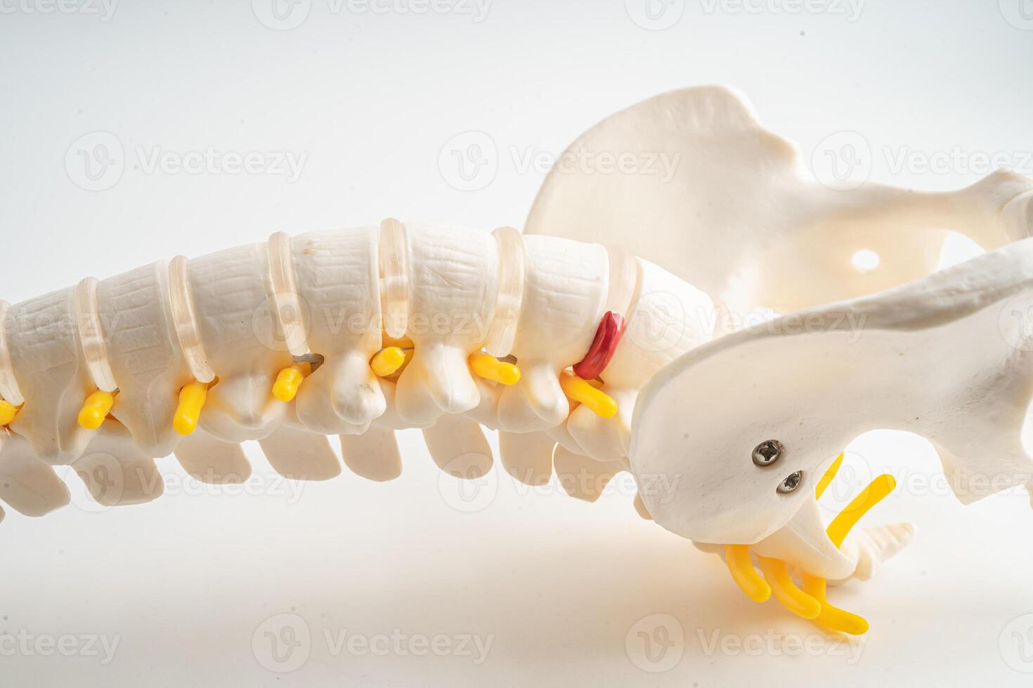 Lumbar spine displaced herniated disc fragment, spinal nerve and bone. Model for treatment medical in the orthopedic department. photo