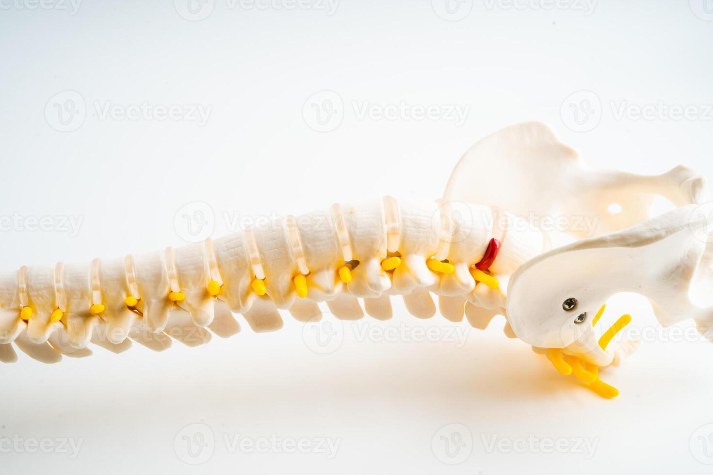 Lumbar spine displaced herniated disc fragment, spinal nerve and bone. Model for treatment medical in the orthopedic department. photo