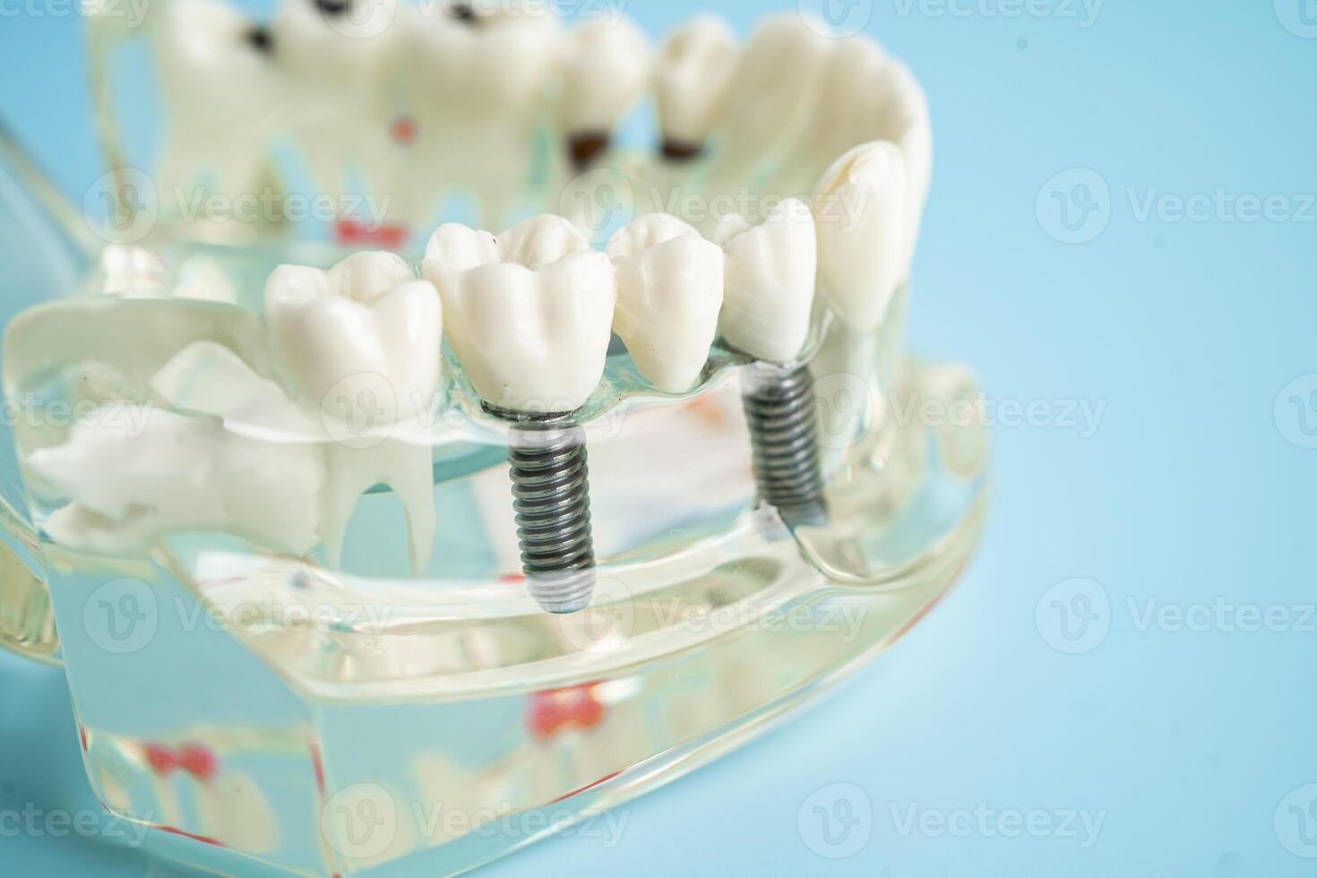Dental implant, artificial tooth roots into jaw, root canal of dental treatment, gum disease, teeth model for dentist studying about dentistry. photo