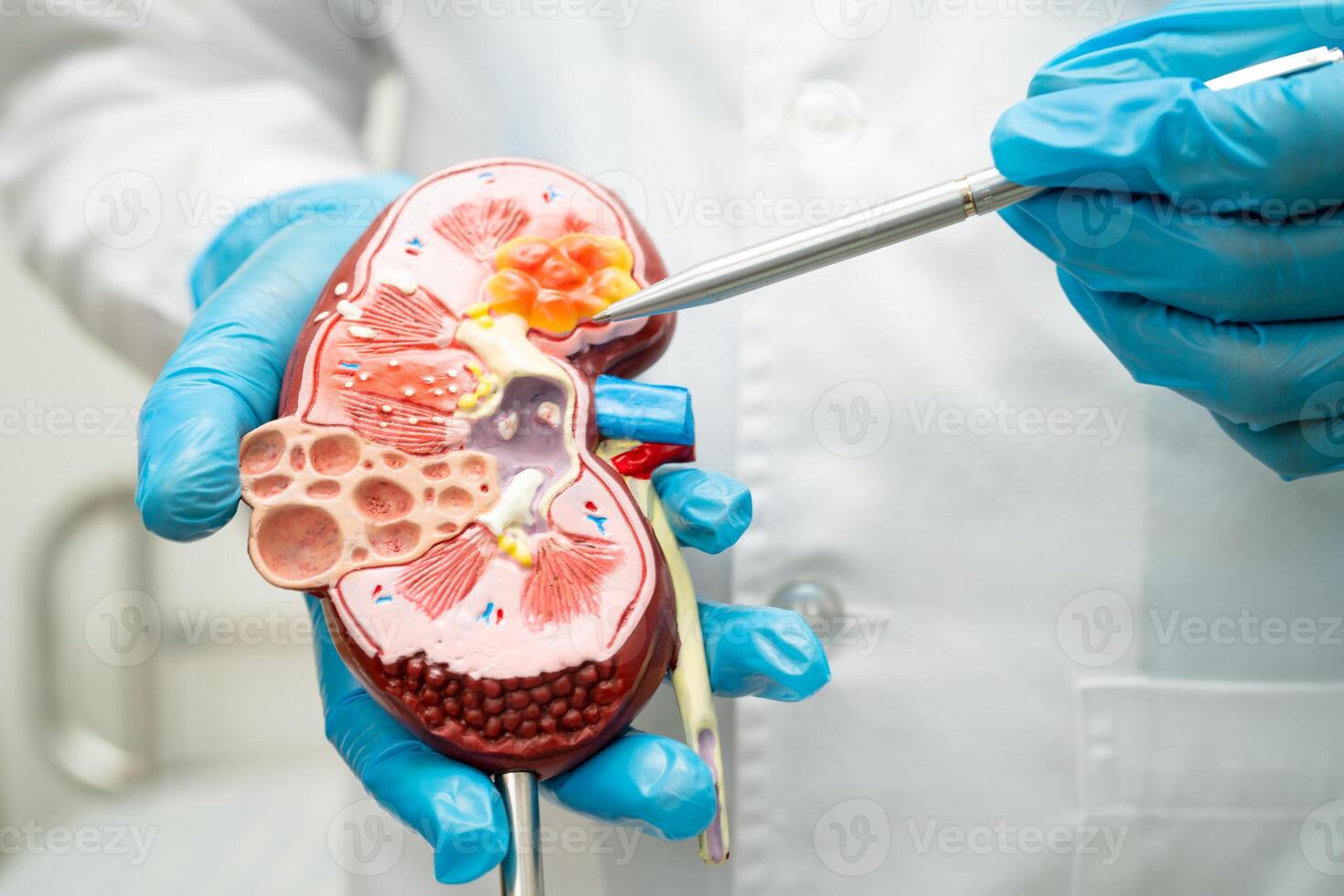 Kidney disease, Chronic kidney disease ckd, Doctor with human model to study and treat in hospital. photo