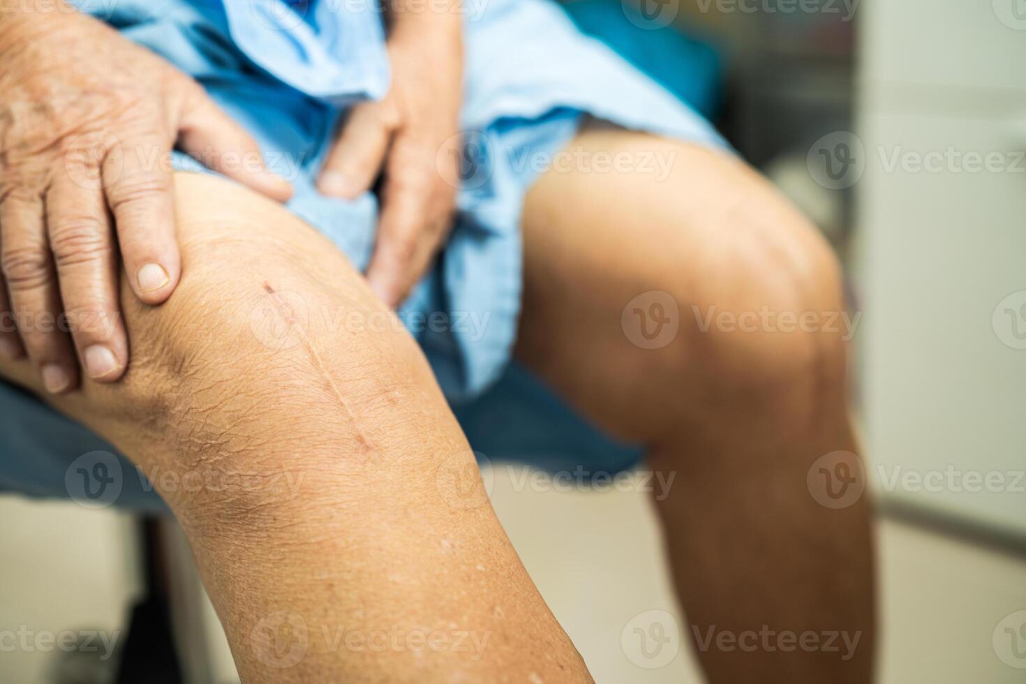 Asian elderly woman patient show her scars surgical total knee joint replacement Suture wound surgery arthroplasty on bed in hospital. photo