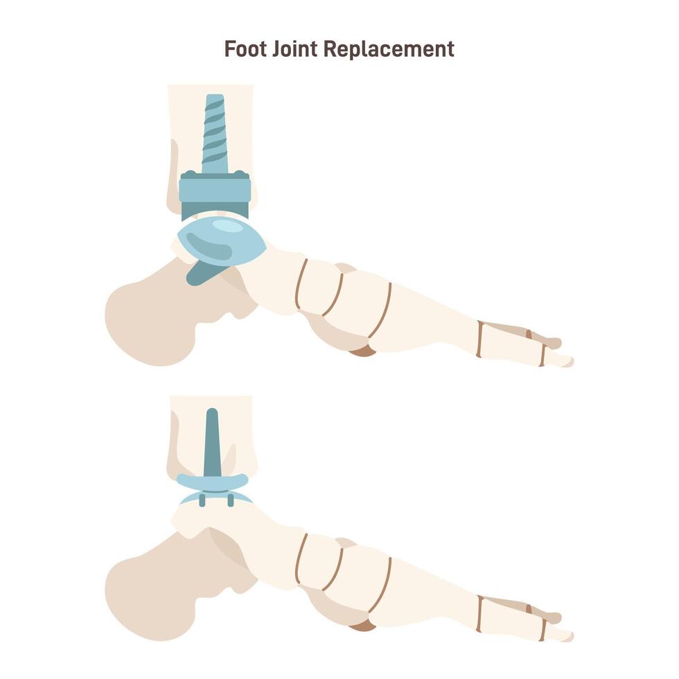 Joint implantation. Injured or distracted human joint replaced with artificial vector