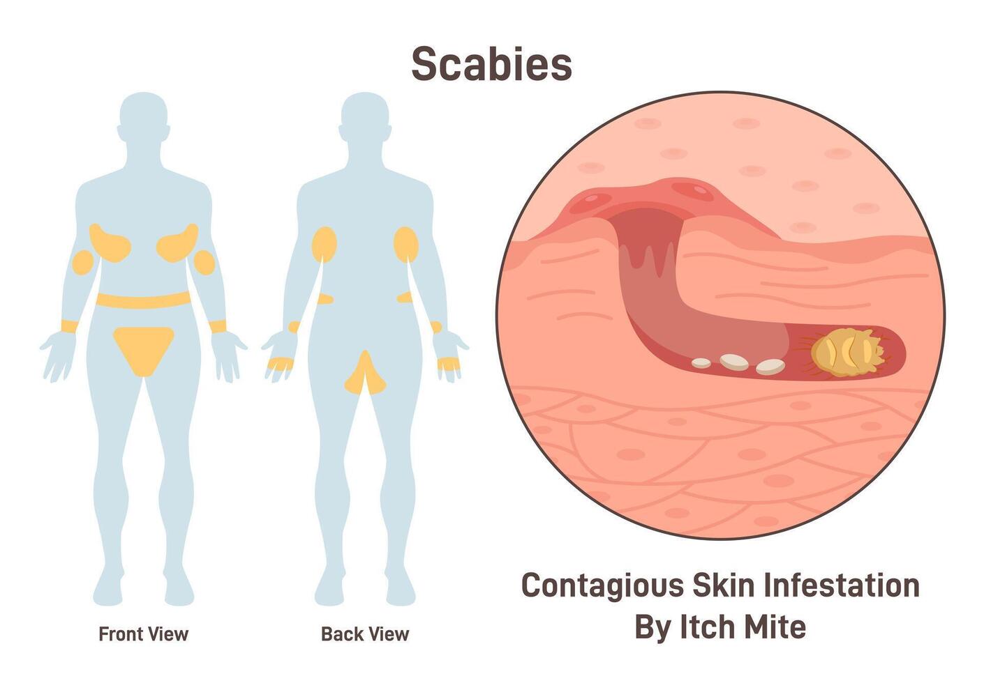 Scabies. Skin infestation with itch mite. Infected microscopic epidermis vector
