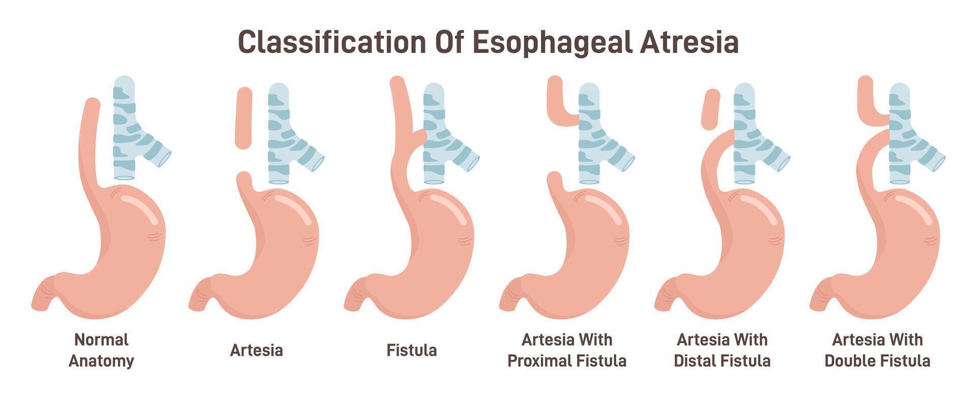 Esophageal atresia types set. Congenital medical condition of trachea vector