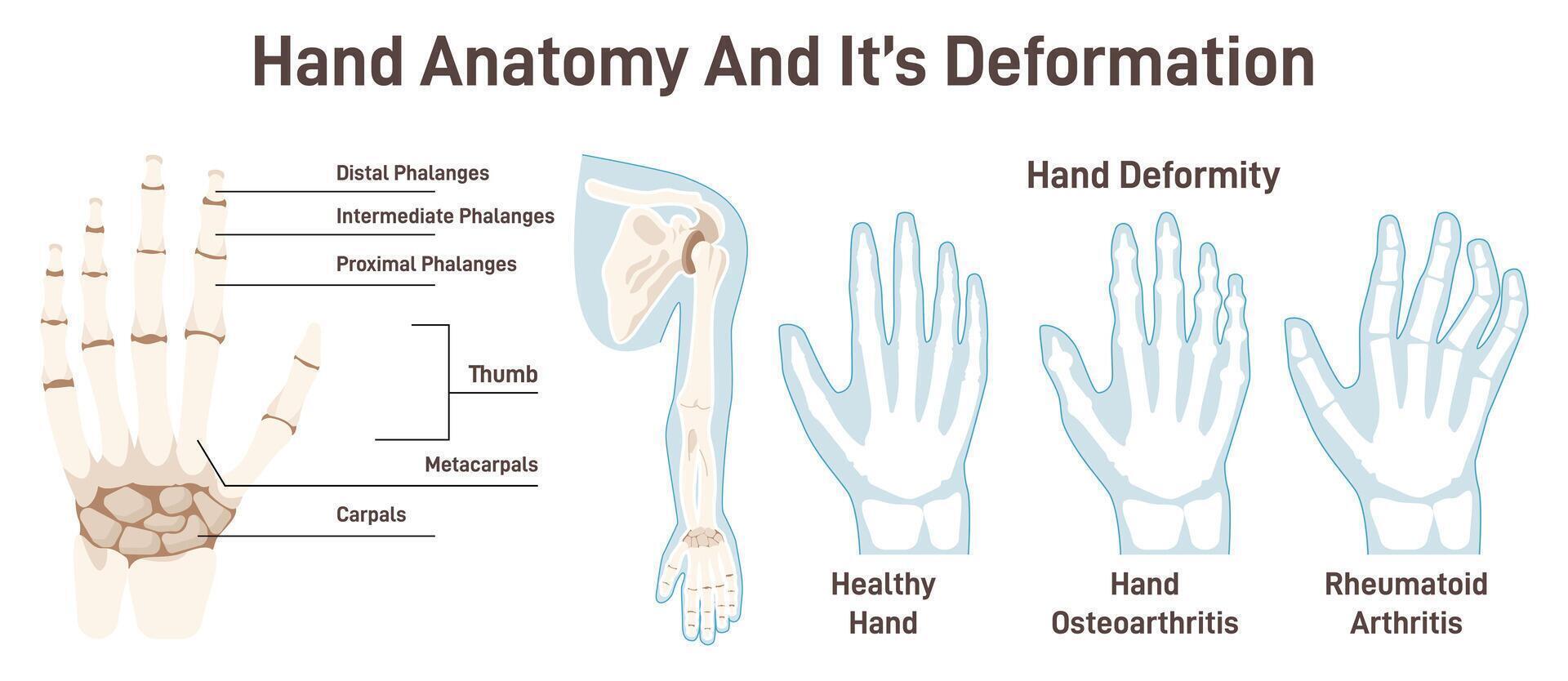 Human hand bones and its deformations. Anatomical structure vector