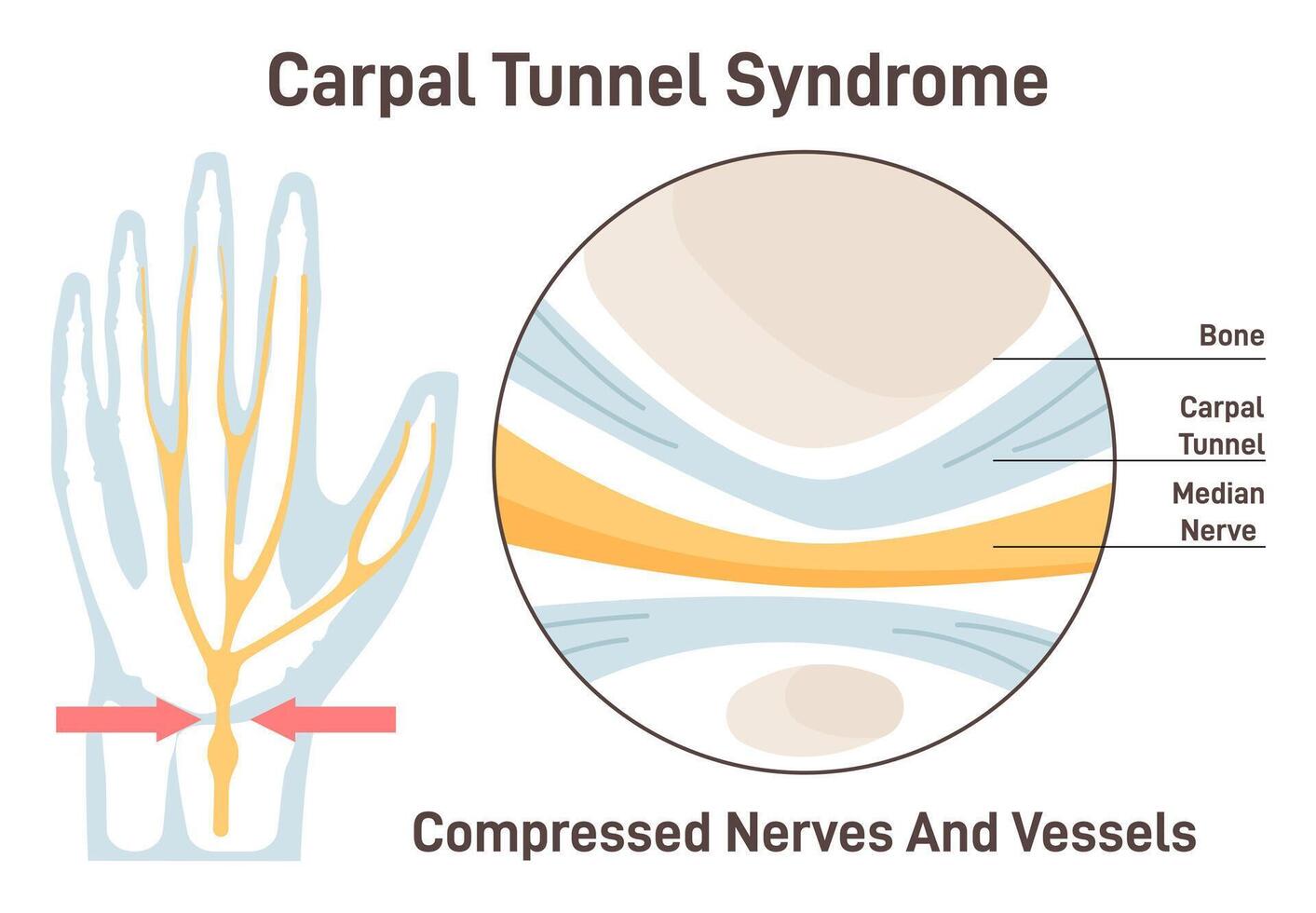 Carpal tunnel syndrome. Compressed median nerve. Carpal tunnel anatomy vector