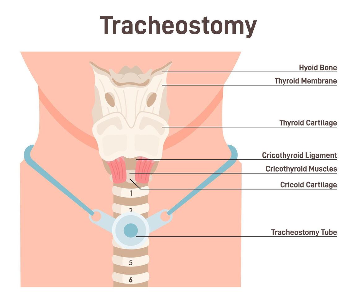 Tracheostomy. Tracheal surgery neutralise airway obstruction. Plastic cannula vector