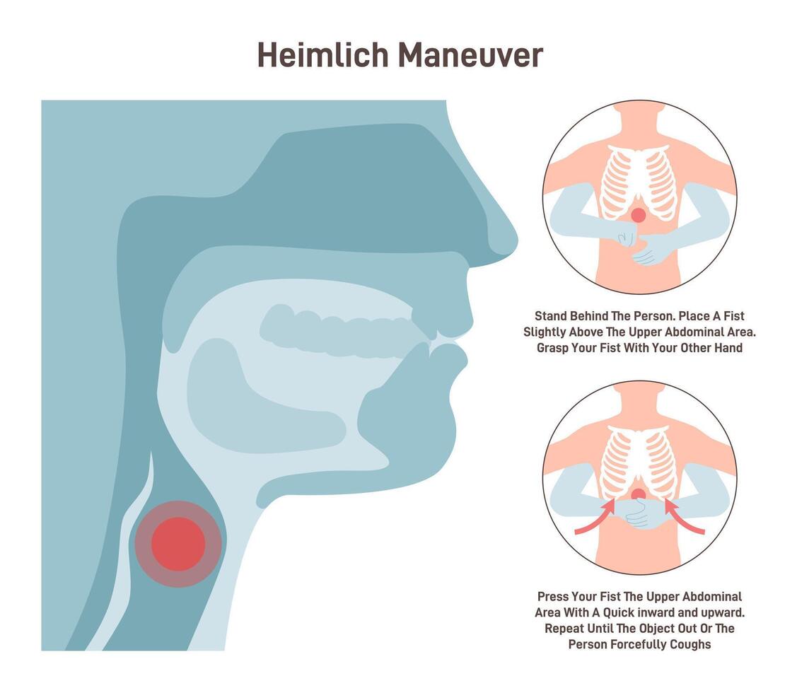 Choking first aid. Heimlich maneuver procedure to remove a foreign vector