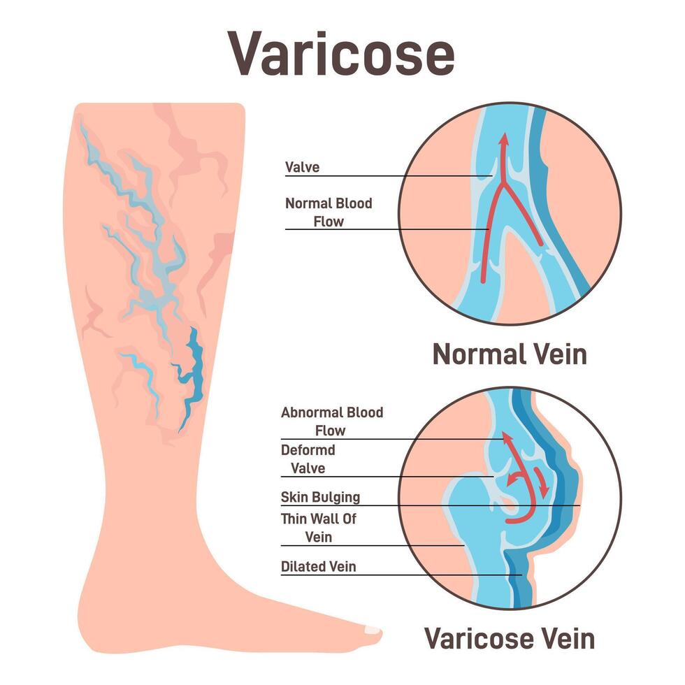 Varicoses. Anatomical diagram of varicose vein and normal healthy vein vector
