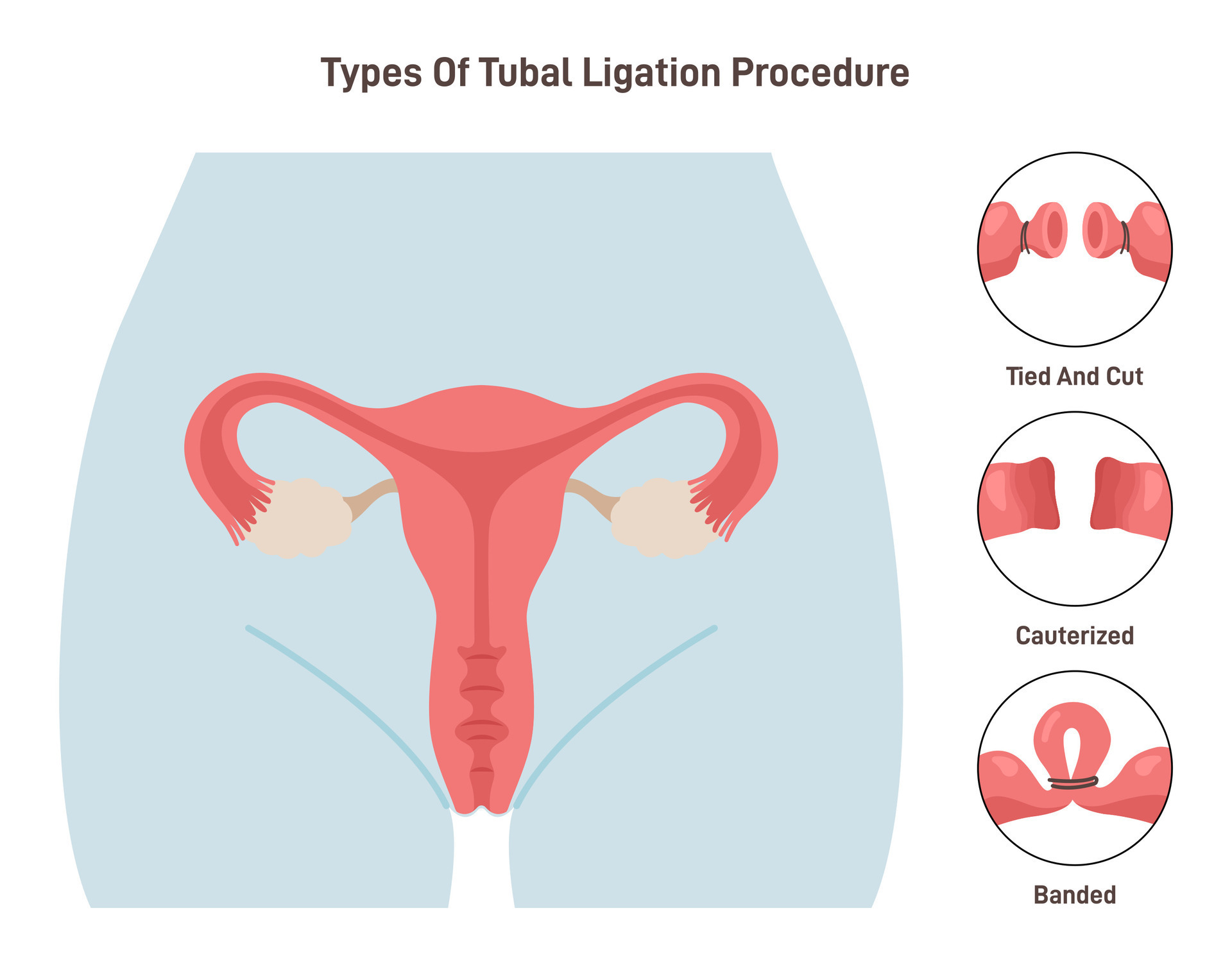 Tubal ligation surgery. Permanent birth control procedure types. Tubes